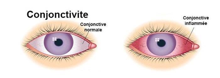 Comment Faire Semblant D'avoir Une Conjonctivite